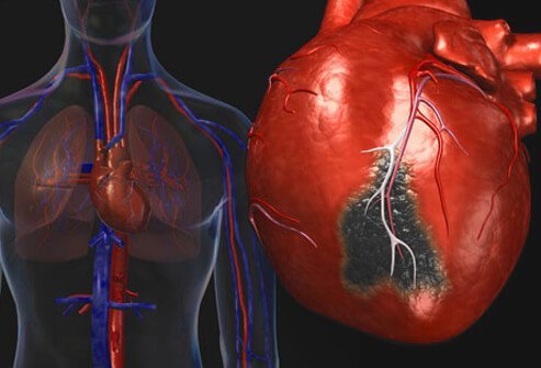 heart disease visual guide