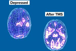 Brain Before and After TMS